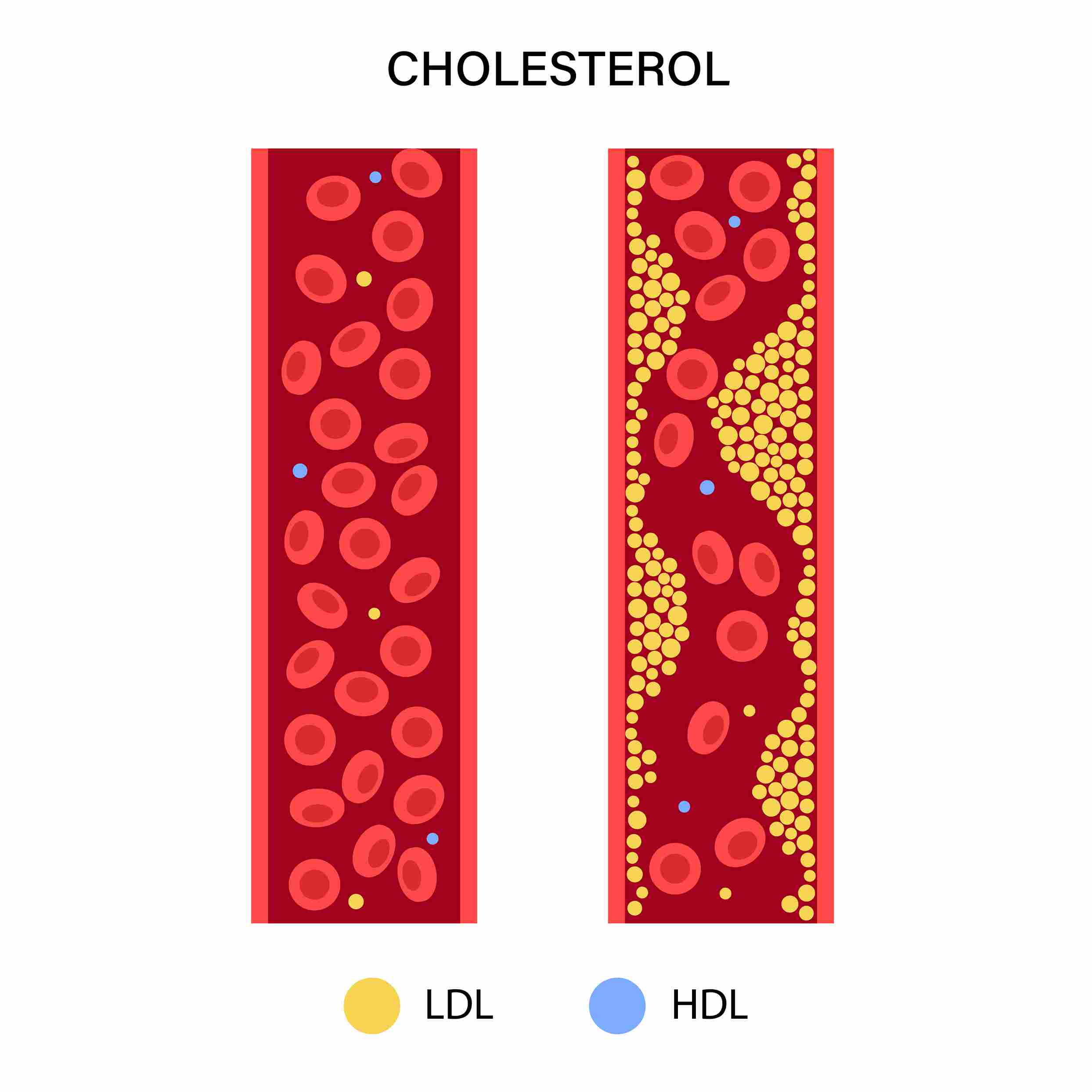 LDL and HDL in Cholesterol